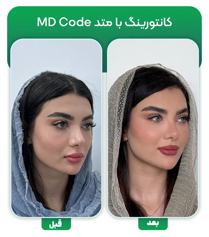 تزریق فیلر با متد ام دی کد