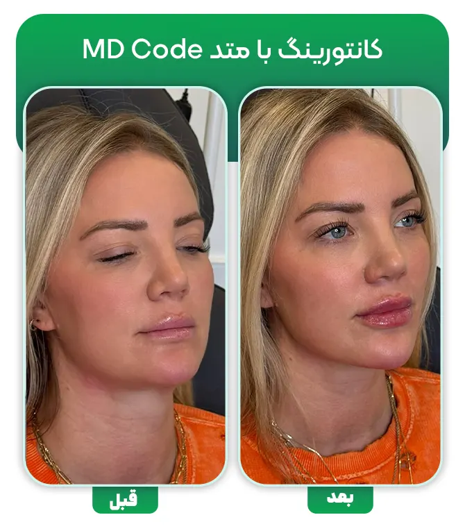 تزریق فیلر با متد ام دی کد