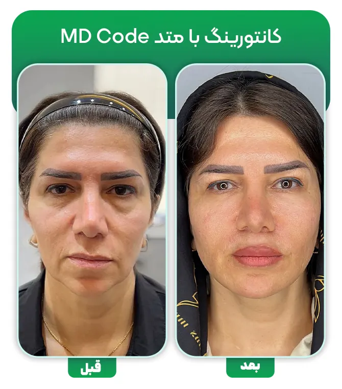 تزریق فیلر با متد ام دی کد