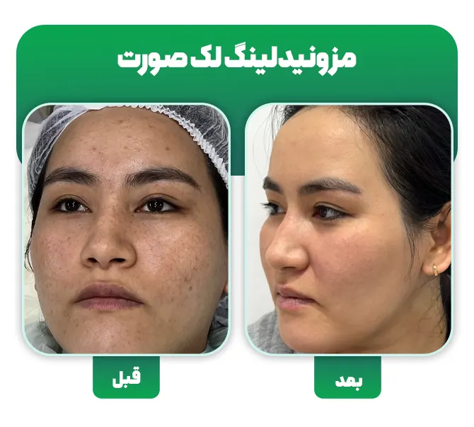 مزونیدلینگ لک صورت