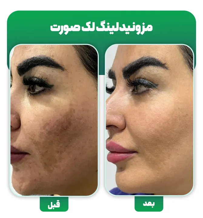 مزونیدلینگ لک صورت
