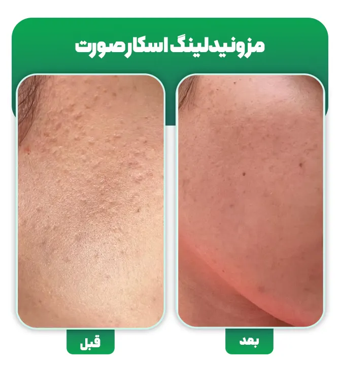 مزونیدلینگ صورت