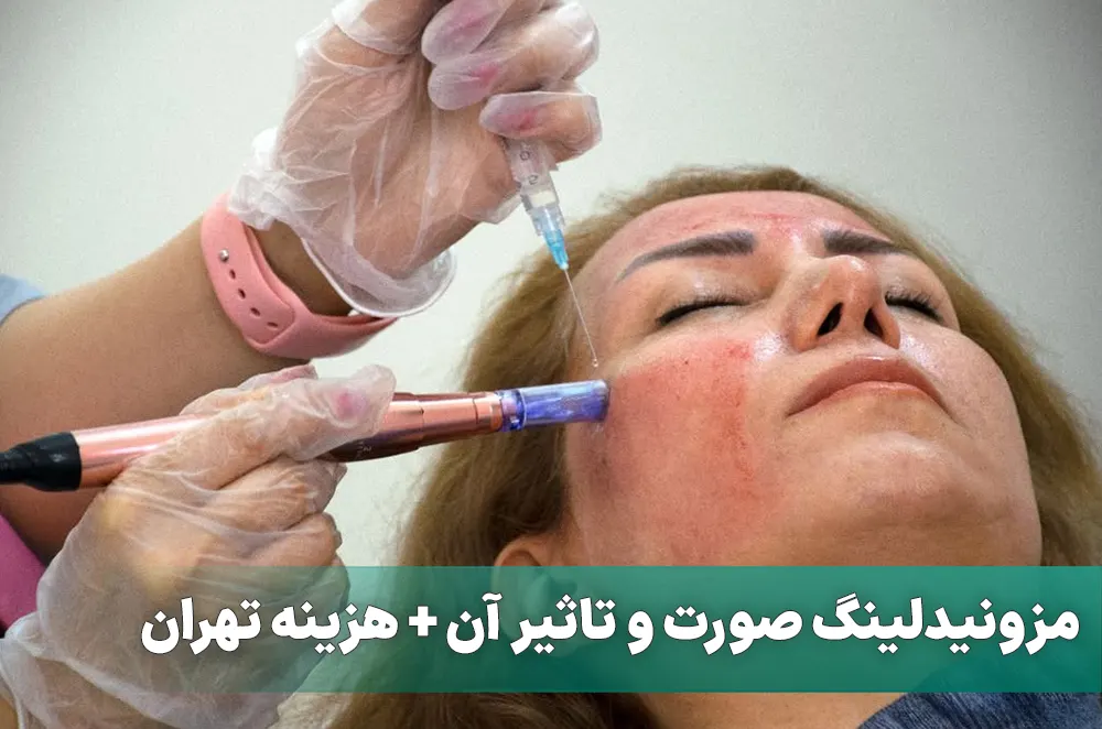 مزونیدلینگ صورت