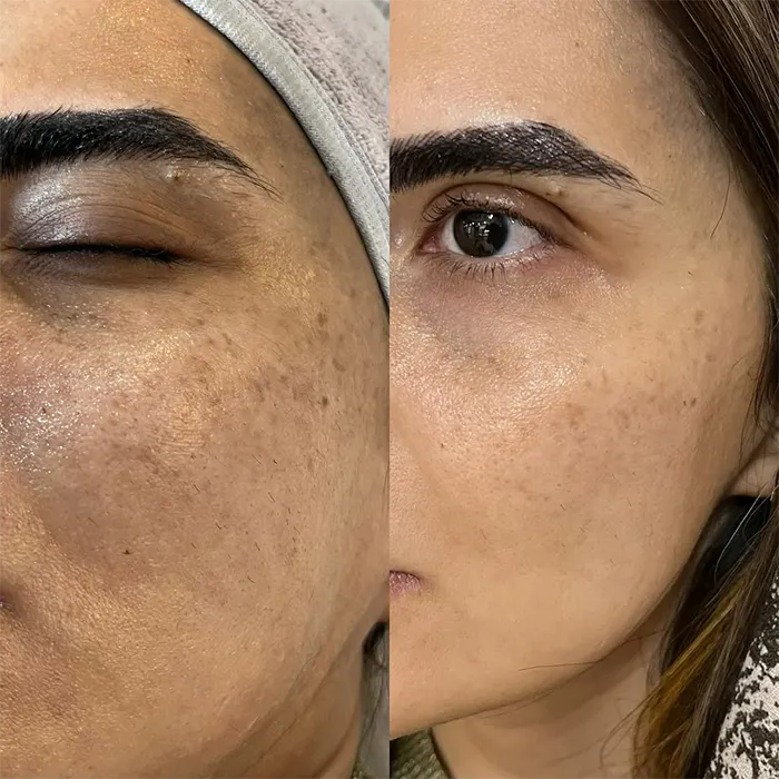 مزوتراپی لک صورت