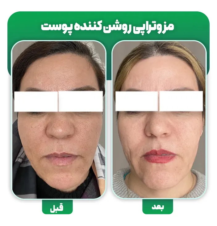 مزوتراپی روشن کننده صورت