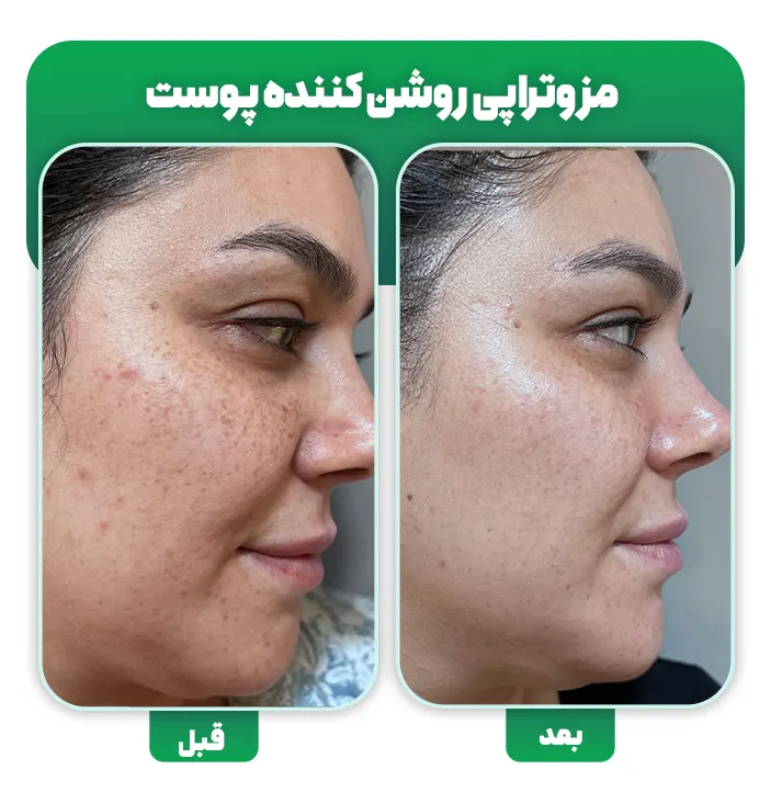 مزوتراپی صورت