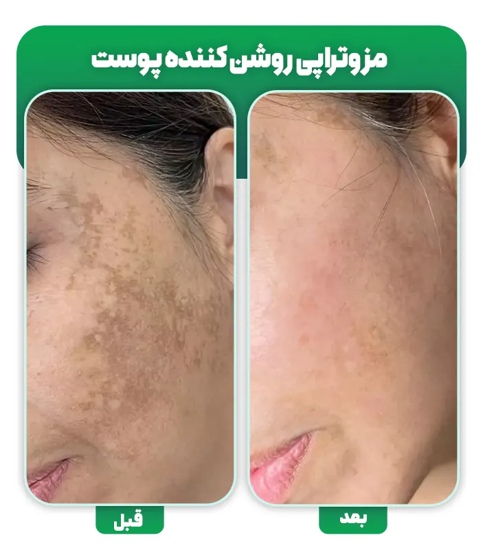 مزوتراپی ضد لک صورت