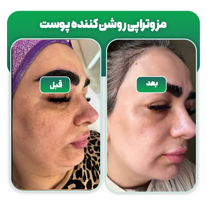 روشن کردن پوست صورت با مزوتراپی
