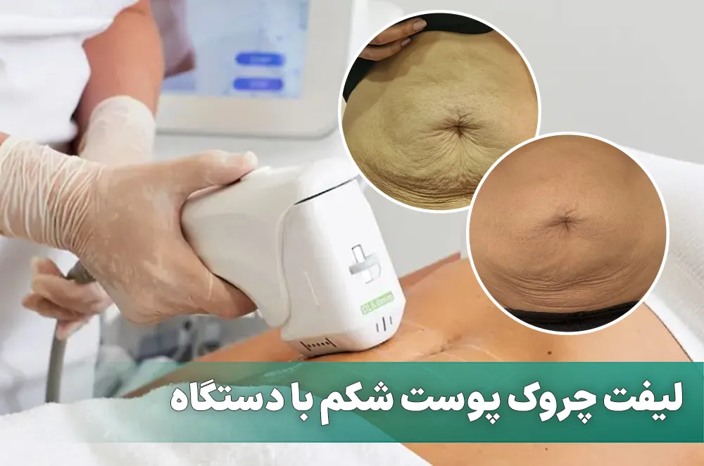 لیفت چروک پوست شکم با دستگاه