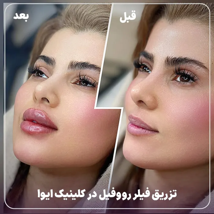 فیلر رووفیل برای لب