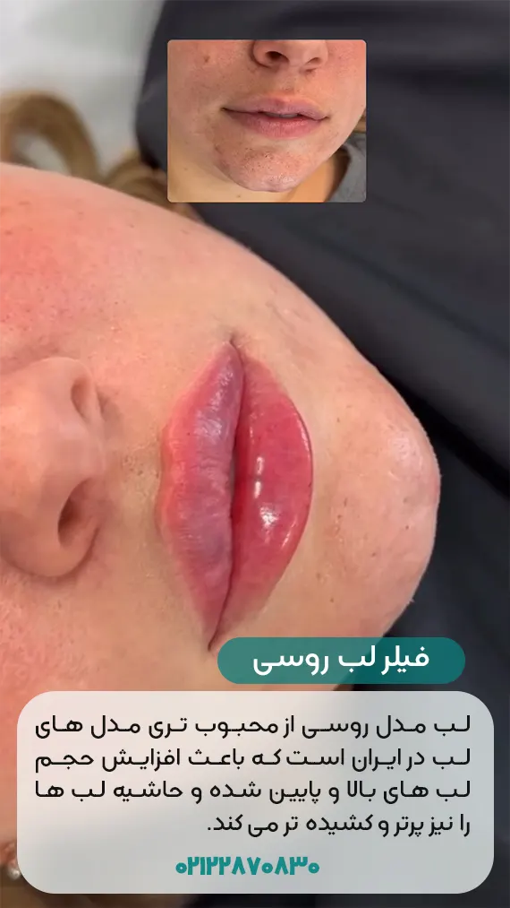 فیلر لب روسی