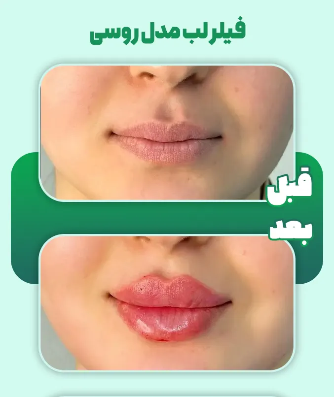 ژل لب مدل روسی