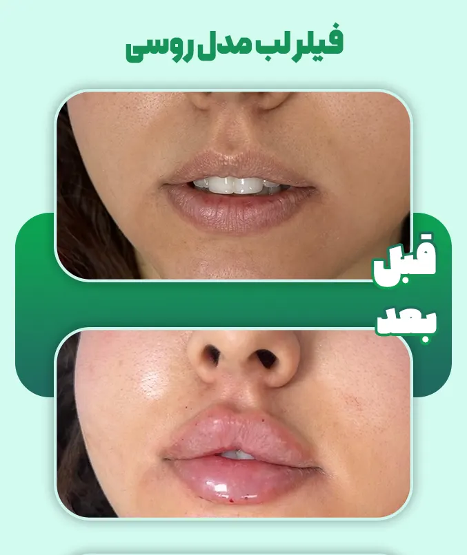ژل لب مدل روسی