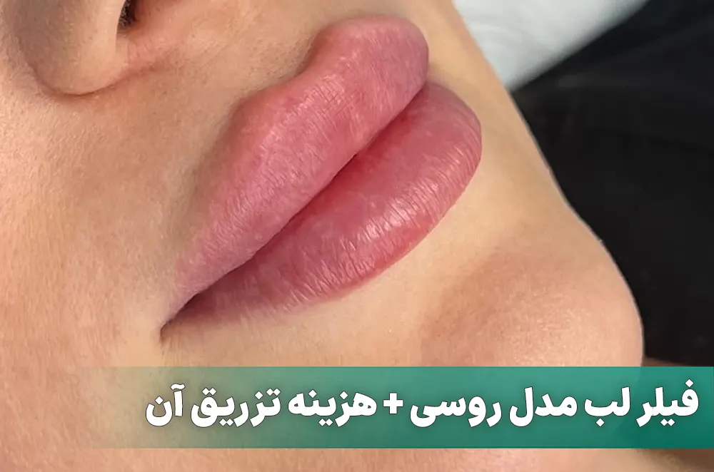 تزریق ژل لب مدل روسی