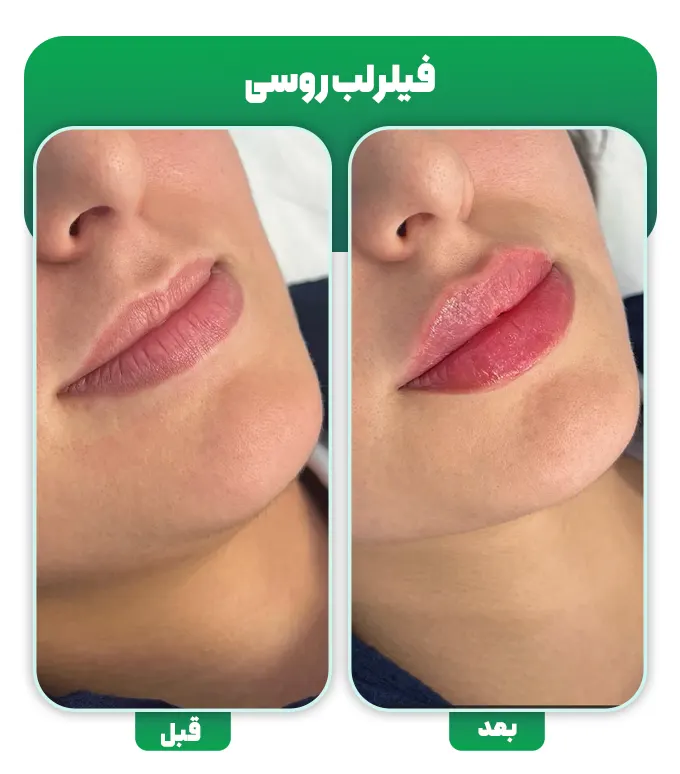 فیلر لب روسی
