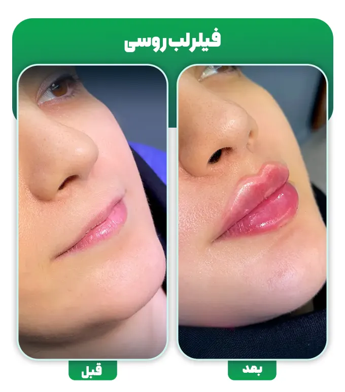 ژل لب مدل روسی