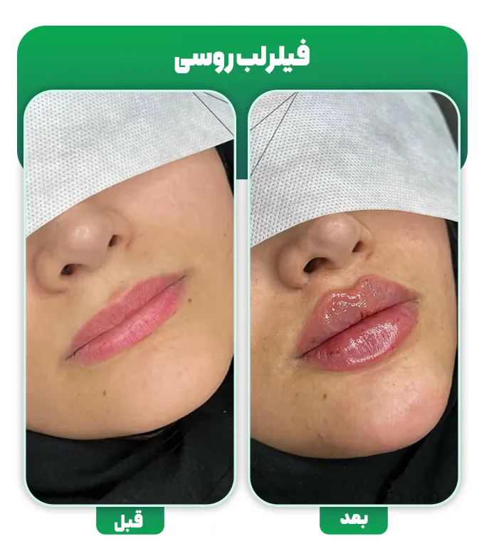 ژل لب مدل روسی