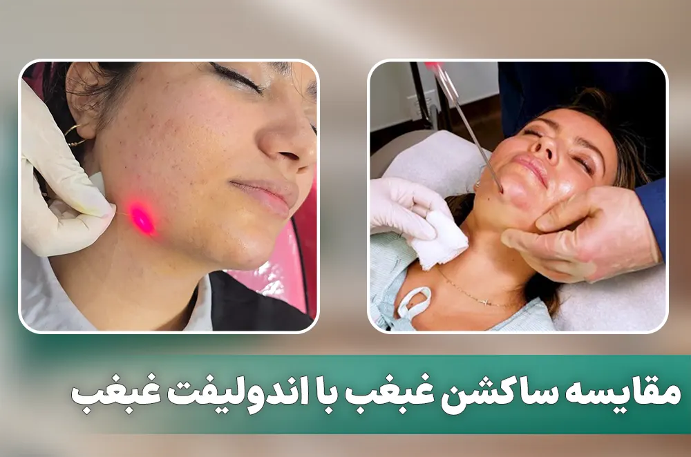 مقایسه لیپوساکشن غبغب با اندولیفت غبغب