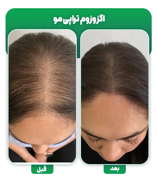 اگزوزوم تراپی مو