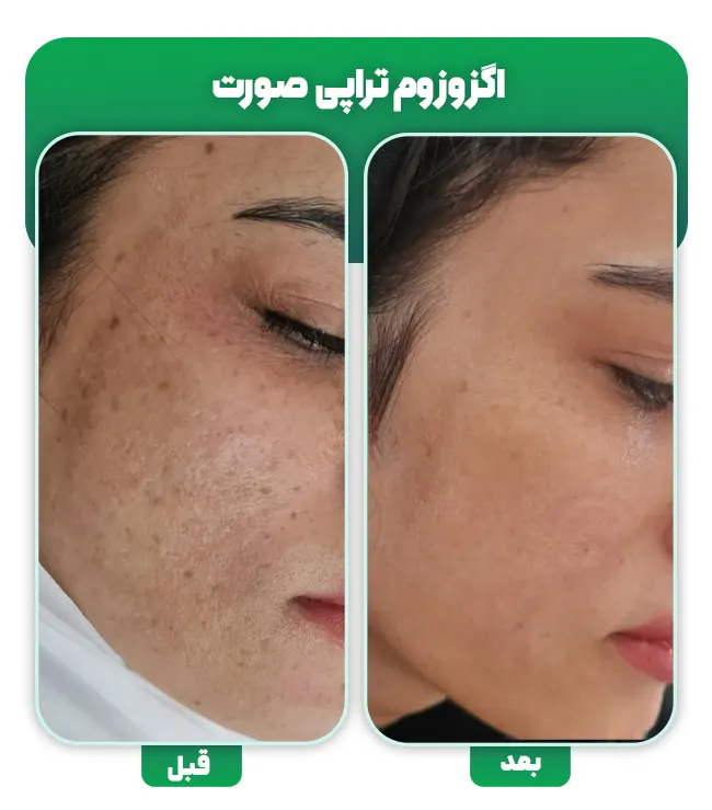 اگزوزوم تراپی صورت