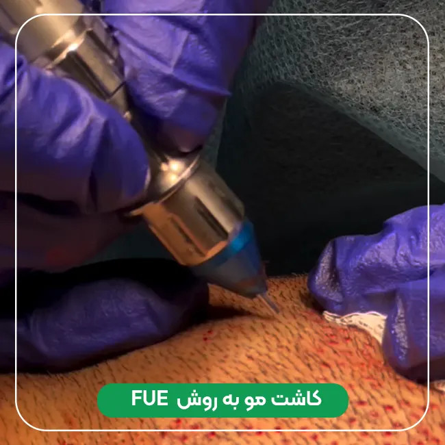 کاشت مو به روش FUE