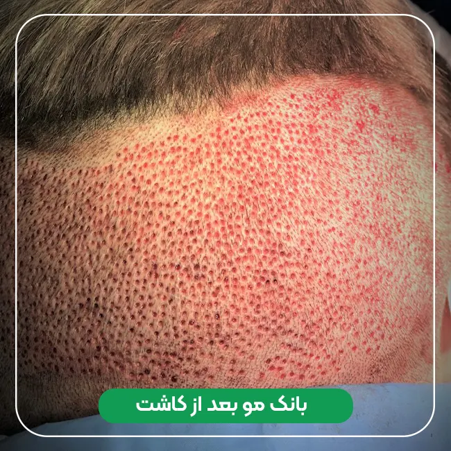 بانک مو بعد از کاشت مو