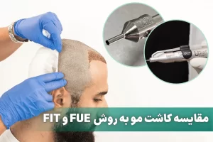 کاشت مو به روش FUE و FIT
