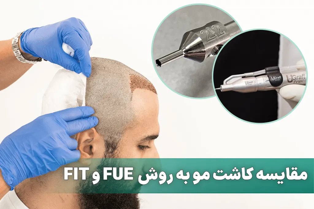 کاشت مو به روش FUE و FIT