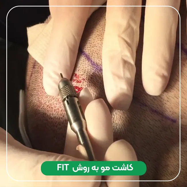کاشت مو به روش FIT