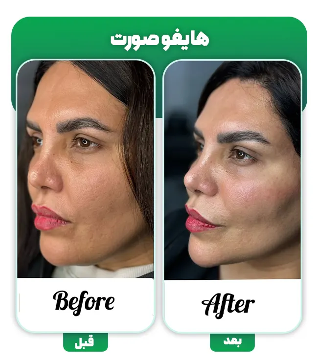قبل بعد هایفو صورت