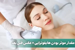 هایفوتراپی صورت