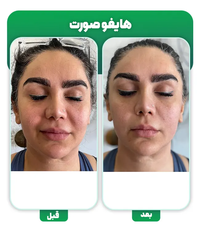 قبل و بعد هایفوتراپی