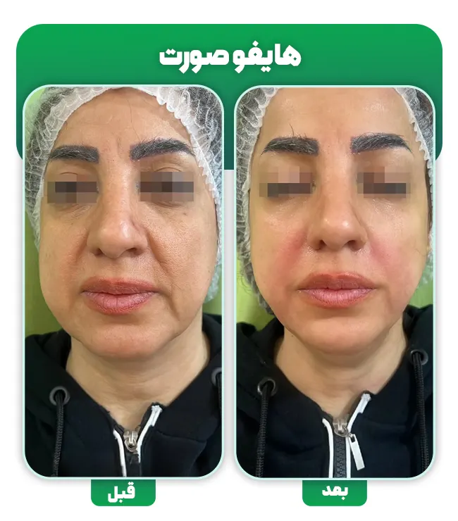 هایفوتراپی صورت قبل بعد