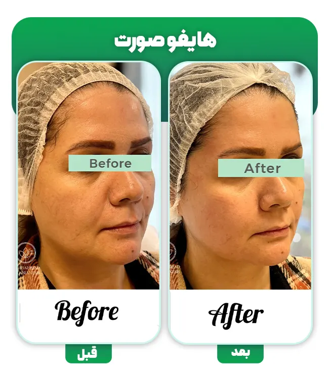 هایفوتراپی صورت قبل بعد