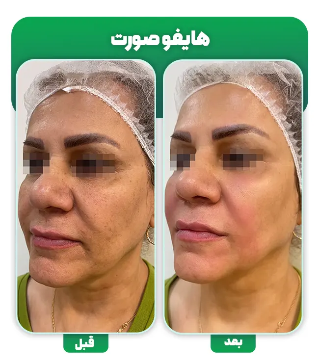 هایفوتراپی صورت