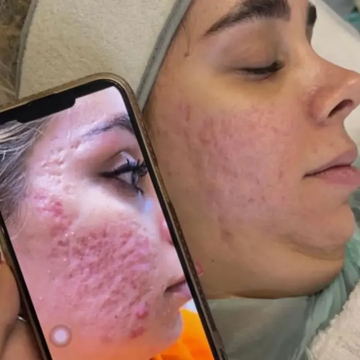 درمان اسکار صورت با سلول بنیادی