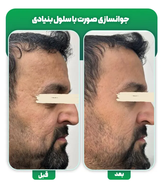 جوانسازی صورت با سلول بنیادی