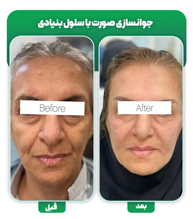 جوانسازی صورت با سلول بنیادی