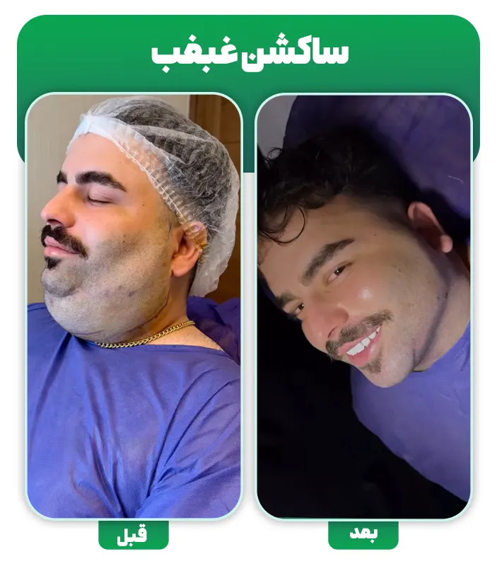 قبل و بعد ساکشن غبغب