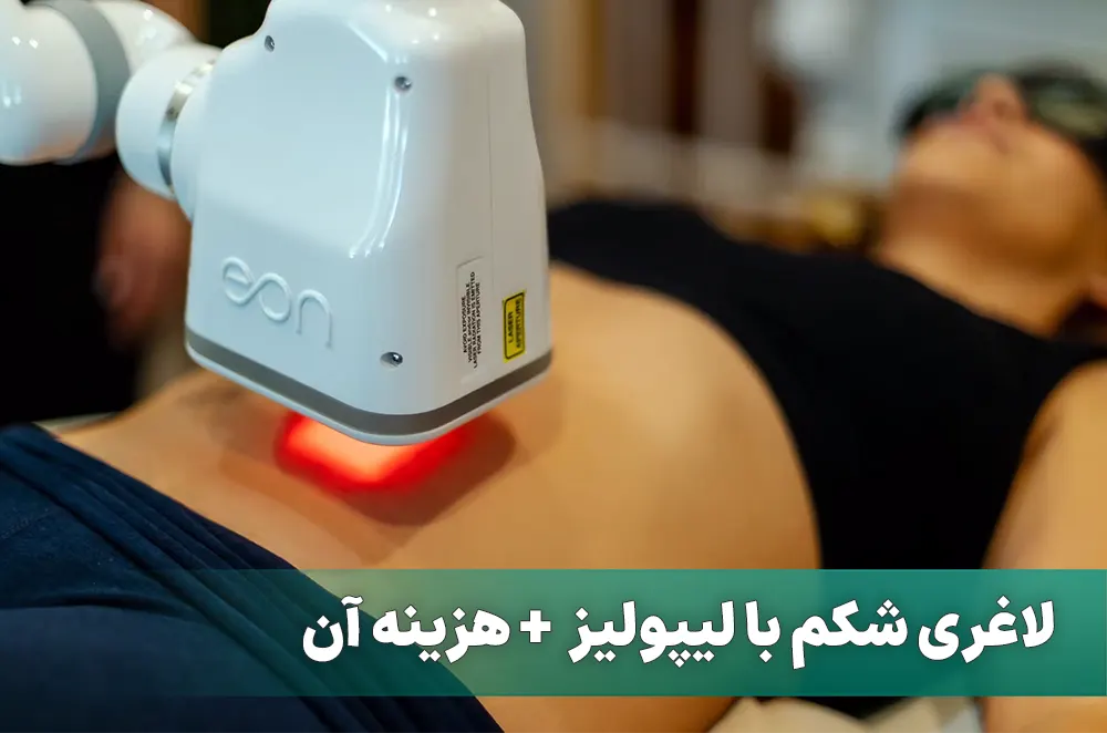 لیپولیز شکم