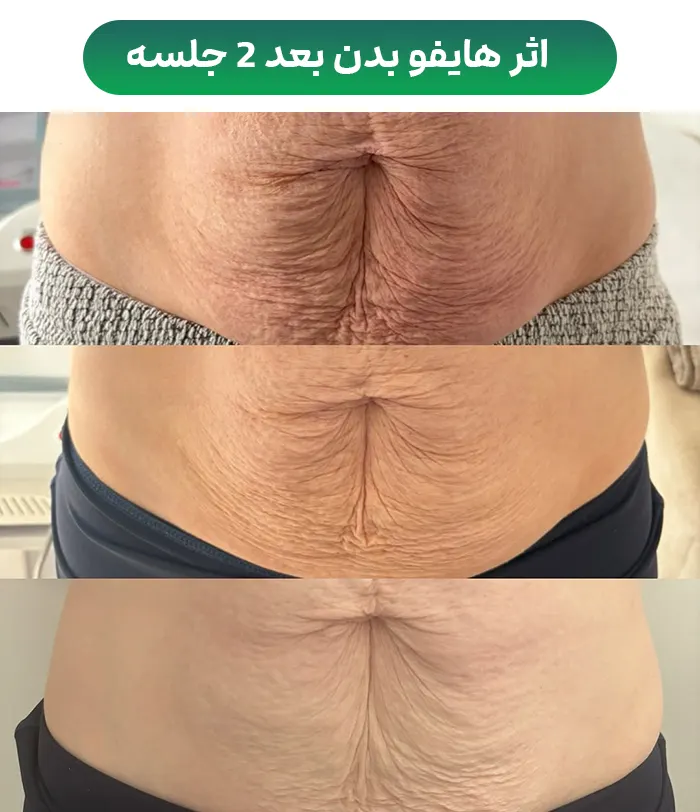 اثر هایفوتراپی بدن