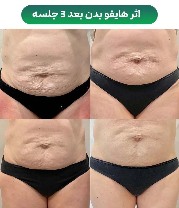 قبل و بعد هایفوتراپی بدن