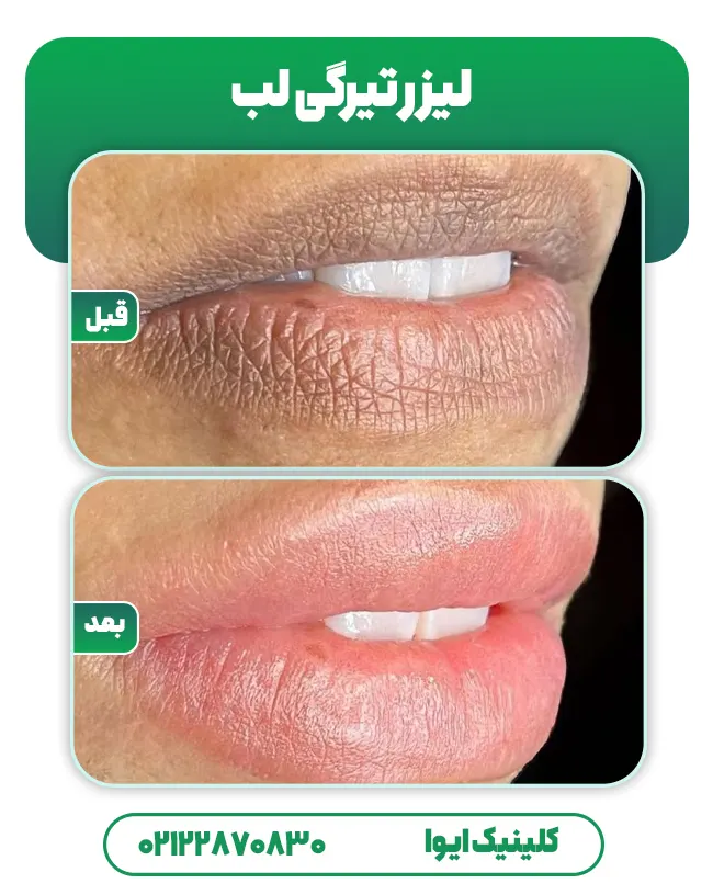 لیزر تیرگی لب