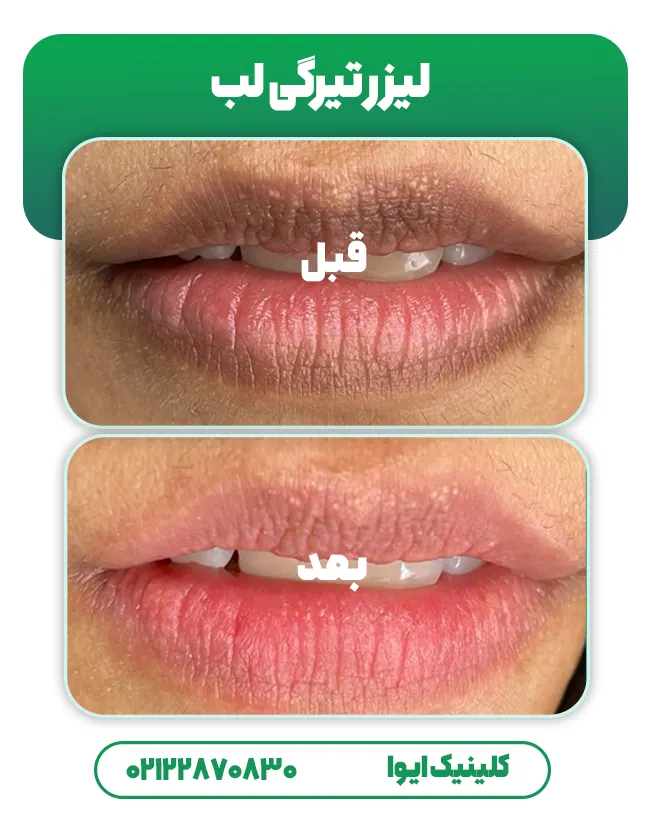 لیزر تیرگی لب