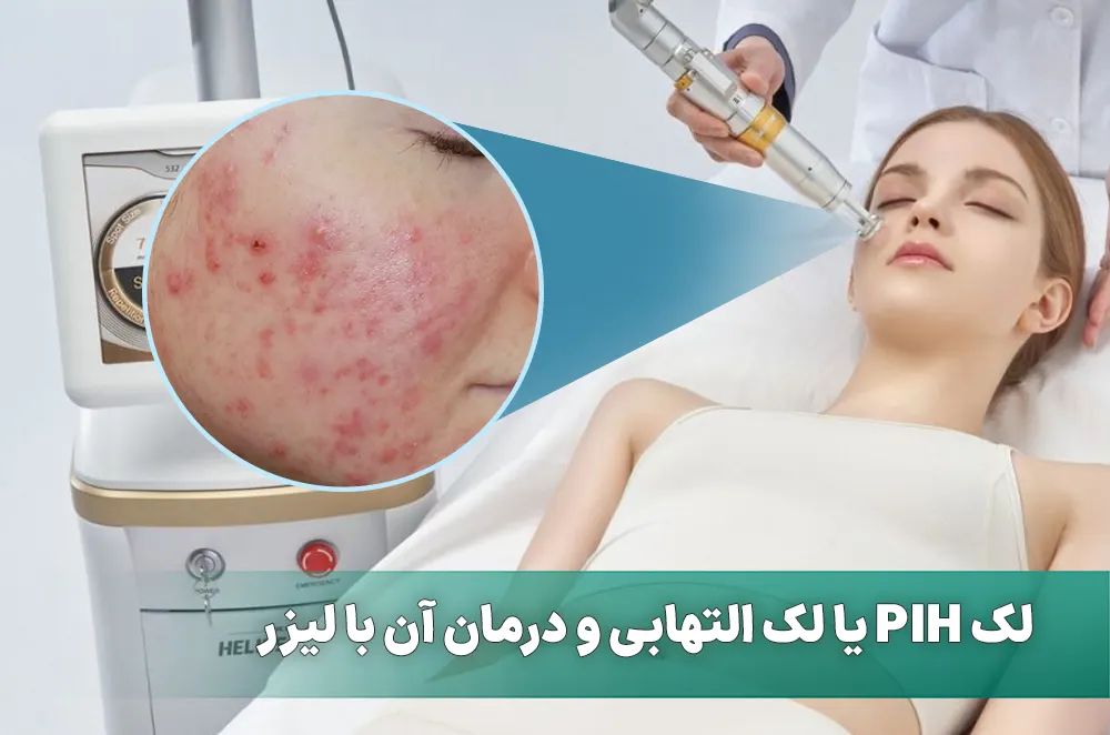 لیزر لک التهابی پوست