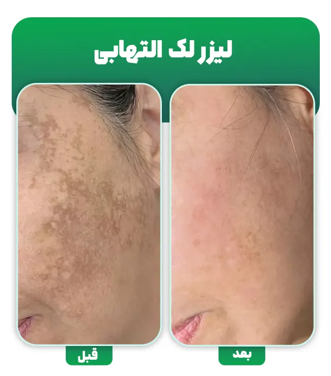 لیزر لک التهابی پوست