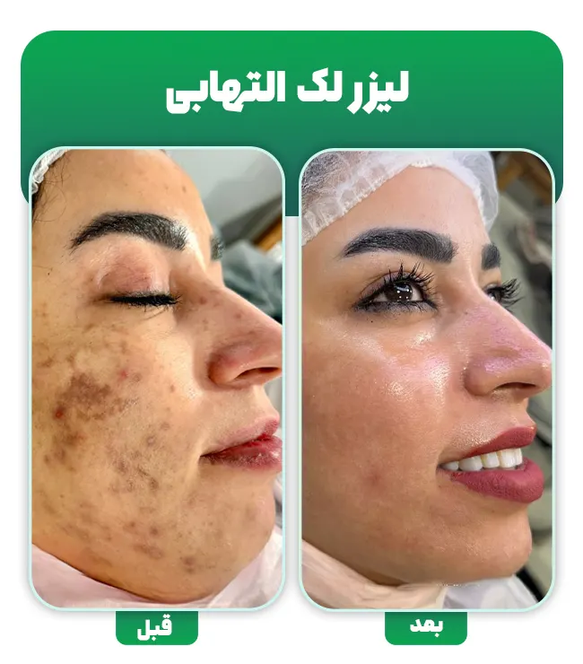 لیزر لک التهابی پوست