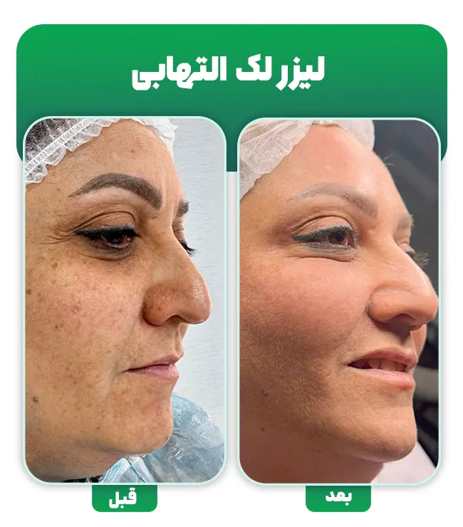 لیزر لک التهابی پوست