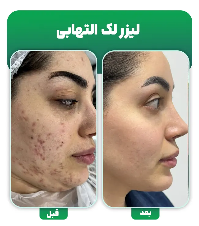 لیزر لک التهابی پوست