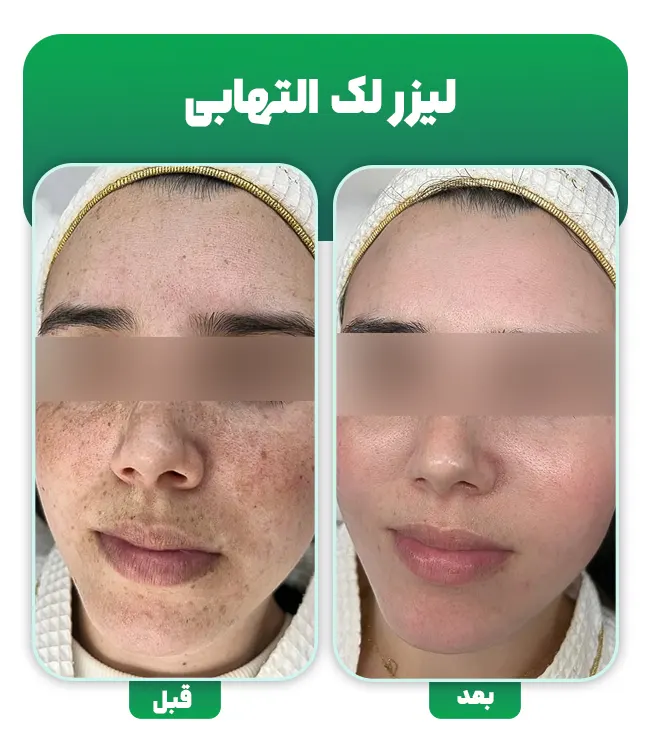 لیزر لک التهابی پوست